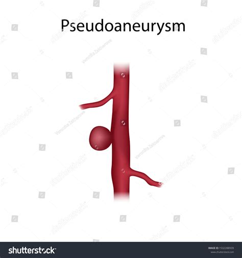 Pseudoaneurysm Aneurysm Blood Vessel Artery Medical Stock Illustration