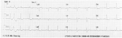 Primary Ventricular Fibrillation In A Patient With Mild Hypercalcemia