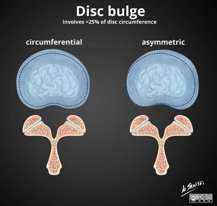 Bulge Disk Xray Polizintra