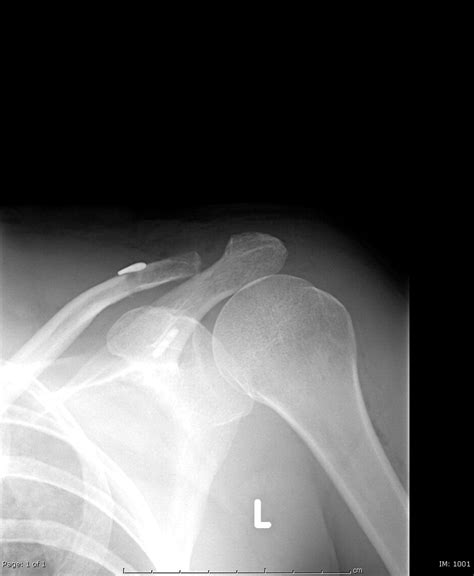 Suture Rupture In Acromioclavicular Joint Dislocations Treated With