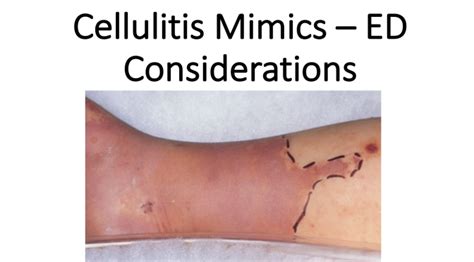 Emergency Medicine Educationcellulitis Mimics Ed