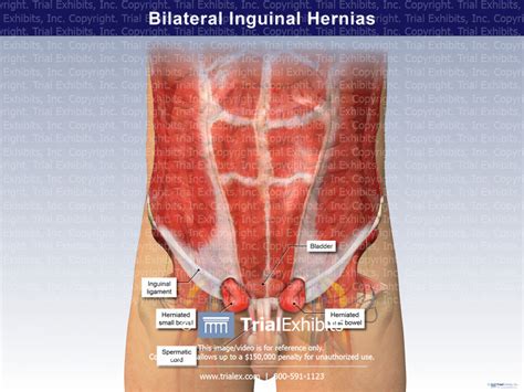 Bilateral Inguinal Hernias Anterior View Trialexhibits Inc