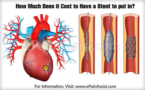How Much Does It Cost To Have A Stent To Put In