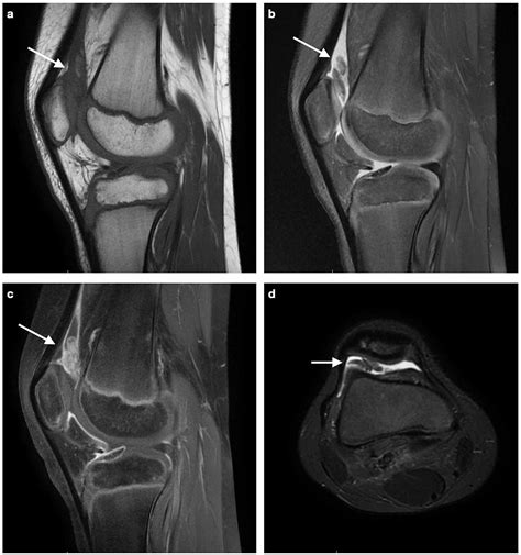 Cureus Pigmented Villonodular Synovitis Of The Knee Joint In A 10
