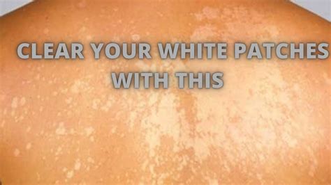Remove White Spots On Face Only 3 Remedies Artofit