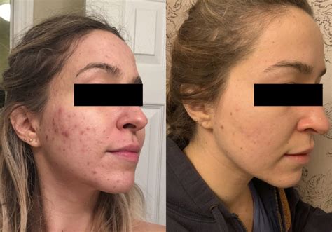 The Secret That Cleared My Severe Hormonal Cystic Itchy Adult Acne After Years Part