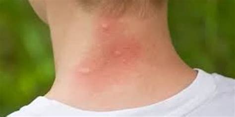 Why Does Mosquito Bite Itch Symptoms And Solutions Explained Y L P C