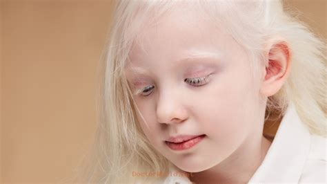 Understanding Albinism Causes Symptoms And Management