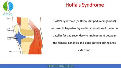 Hoffas Syndrome By Orthofixar Orthopedic Medium