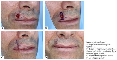 Surgical And Cosmetic Dermatology Perioral Reconstruction After Mohs