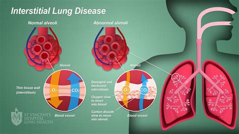 Interstitial Lung Disease Life Expectancy Treatment And Types