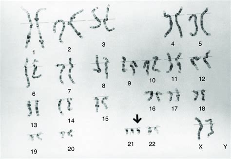 Karyotype Of Trisomy 21 Karyotype The Arrow Indicates Extra Chromosome 21 Download