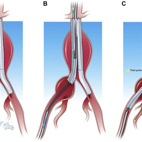 The Iliac Branch Endoprosthesis Endovascular Aortic Aneurysm Repair