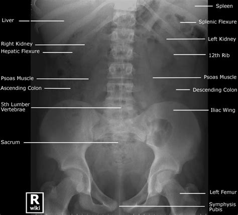 Athletic injuries of the lateral abdominal wall: Labeled Abdominal XRay Anatomy - KUB #Anatomy #Radiology ... | GrepMed