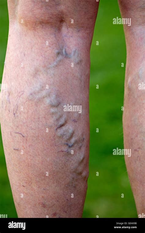 Varicose Veins Swollen Enlarged Veins And Distorted Skin In Legs