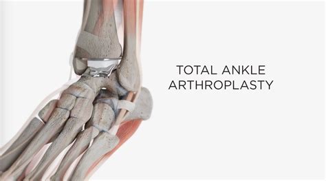 Ankle Replacement Surgery Frequently Asked Questions Exactech