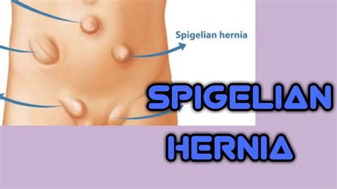 What Is A Hernia Hernia In Detail Mind And Body