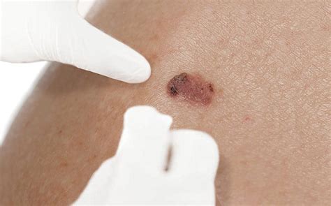 Squamous Cell Carcinoma Scc Symptoms Stages Risk Factors And