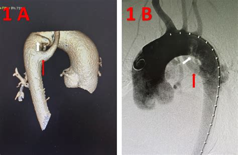Figure 1 From Embolization Of Aortopulmonary Collateral Artery