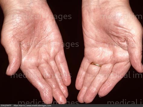 Stock Image Dermatology Mild To Moderate Palmar Psoriasis Dry Cracked