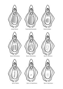 Swollen Hymenal Remnants