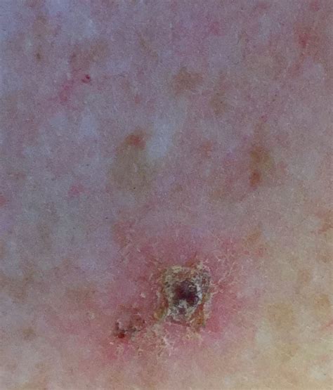Morgellons Disease Pictures Timesocket