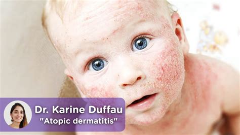 Child Atopic Dermatitis The Treatment To Follow Mediquo