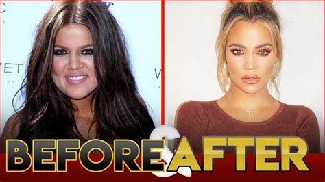 Khloe Kardashian Plastic Surgery Before And After