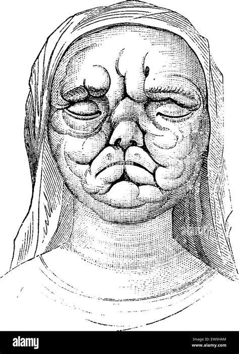 Leprosy Or Hansens Disease Showing A Woman With Facial Skin