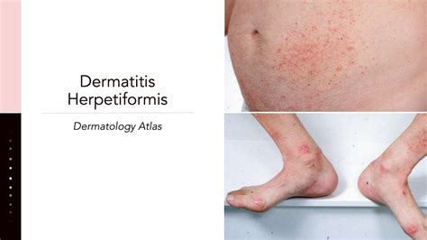 Dermatitis Herpetiformis Youtube
