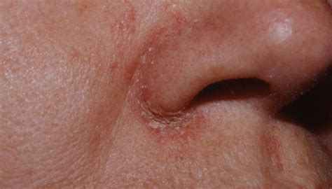 Dry Flaky Skin On Face Dibandingkan