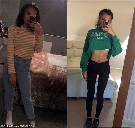 Anorexic Student Who Dropped To Six Stone Turns Her Life Around I