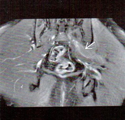 Mri Appearance In Piriformis Syndrome Illinois Chiropractic Society