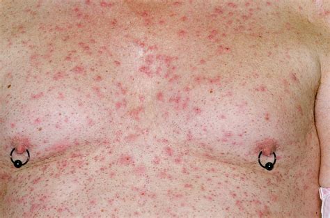 Folliculitis On The Chest Photograph By Dr P Marazziscience Photo Library