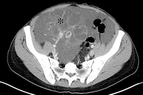 Mucinous Neoplasms Of The Ovary Radiologic Pathologic Correlation