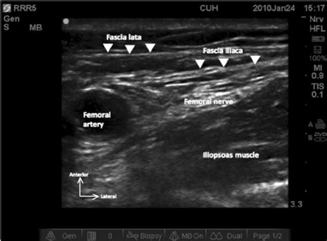 Scout Scan Of The Left Femoral Nerve Short Axis At The Level Of