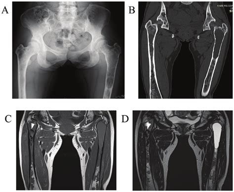 Initial Imaging Findings In A 37 Year Old Patient With Polyostotic