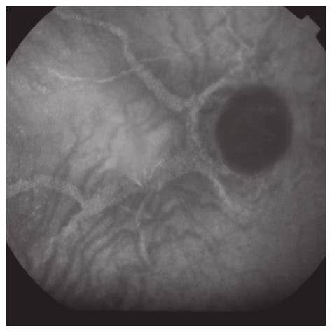 Color Fundus Photograph In An Eye With Angioid Streaks And Choroidal