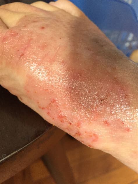 What Is Eczema Skinsharesg