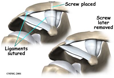 Acromioclavicular Joint Separation Central Orthopedic Group