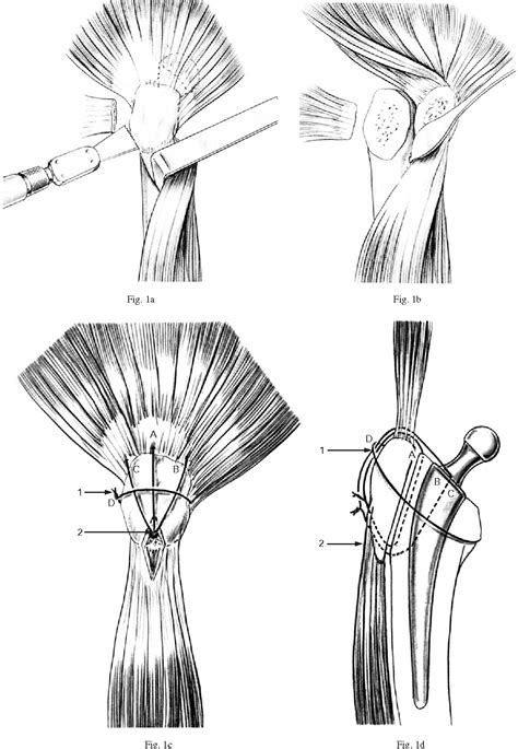 Figure 1 From Trochanteric Slide Osteotomy In Revision Total Hip