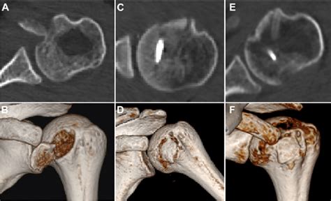 Avulsion Fracture Of Lesser Tuberosity Was Assessed By 3d Ct Pre And