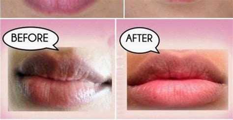 How To Get Rid Of Dark Lips Fast Permanently Naturally Remove Black