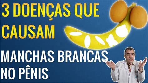 3 Doenças Que Causam Manchas Brancas No PÊnis Youtube