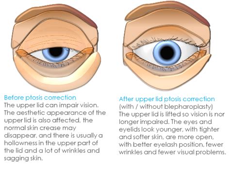 eyelid ptosis condition and treatment for adults clinica london