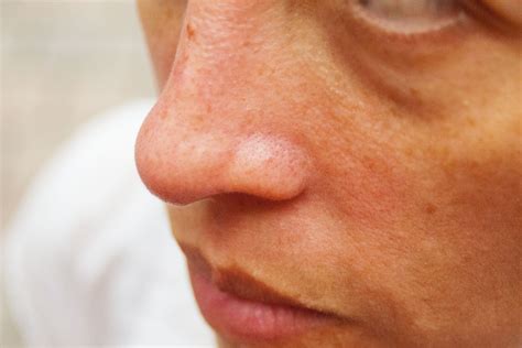 Red Irritated Skin Around The Nose Causes And Solutions Heidi Salon