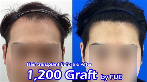 Ahtcs clinic is located in the doctor's plaza near 2 talwar , karachi. FUE Hair transplant for asian_Nobleline asian hair ...