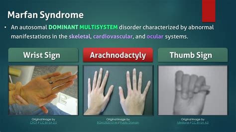 Marfan Syndrome Youtube