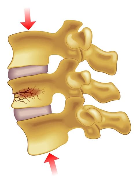 Spinal Fracture Sarasota Spine Specialists