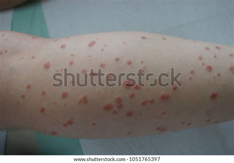 Guttate Psoriasis On Right Leg Stock Photo 1051765397 Shutterstock
